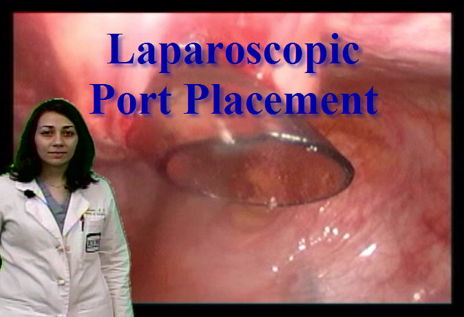Surgical Subspecialties: Laparoscopic Port Placement - Anatomy Guy