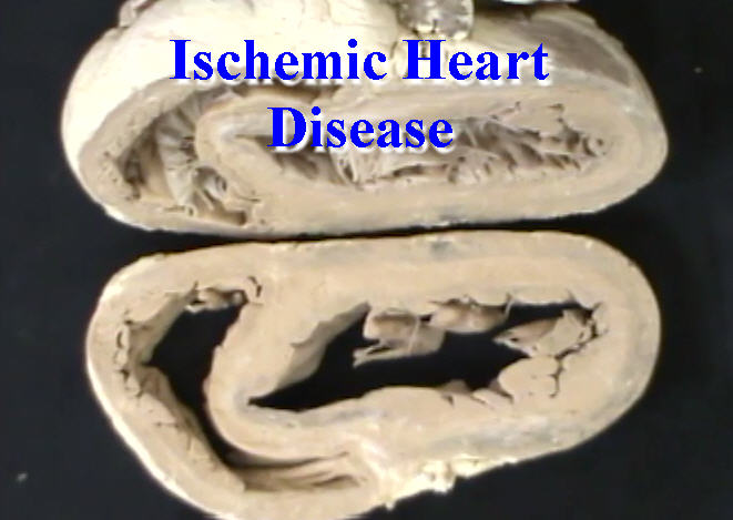 Cardiac Pathology: Ischemic Heart Disease - Anatomy Guy