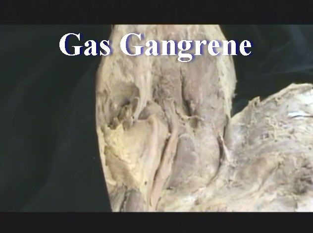Immunology: Gas Gangrene - Anatomy Guy