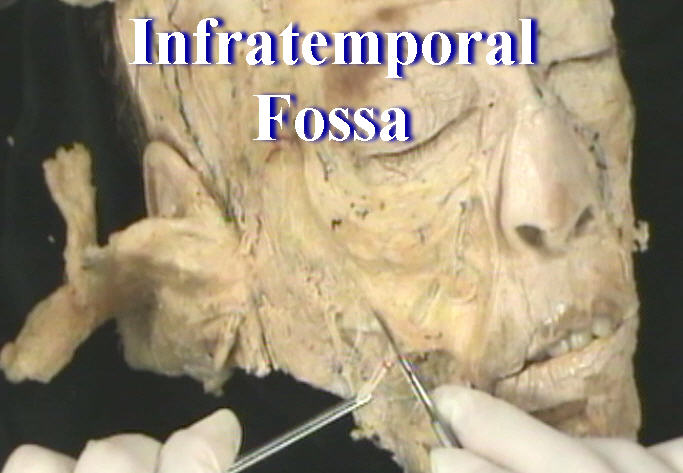 Dissection: Infratemporal Fossa - Anatomy Guy
